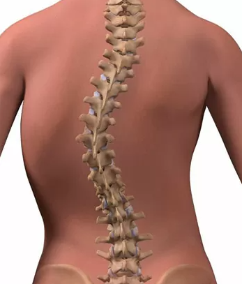 Escoliosis