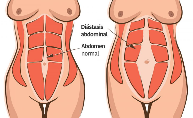 Diástasis Abdominal