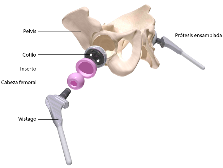 Prótesis de Cadera